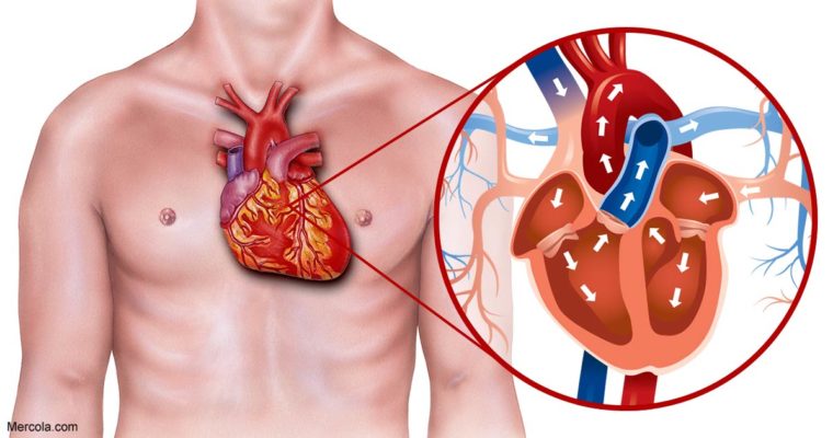 How Is Heart Blockage Treated 