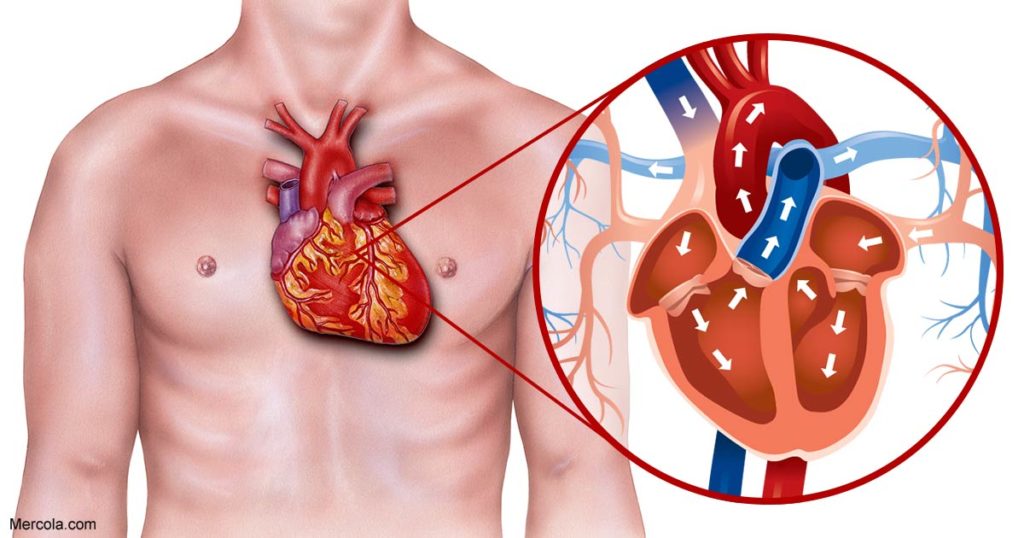 blockage of heart